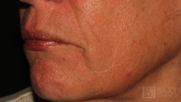 Fillers Before - Paramus, NJ