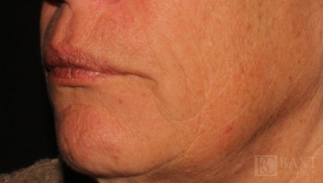 Fillers After - Paramus, NJ
