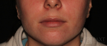 Fillers Before - Paramus, NJ