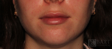 Fillers After - Paramus, NJ