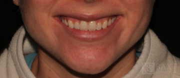 Fillers Before - Paramus, NJ