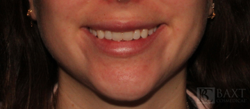 Fillers After - Paramus, NJ