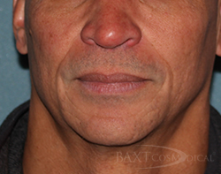 Fillers After - Paramus, NJ