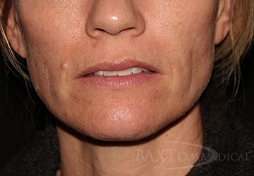 Fillers Before - Paramus, NJ Fillers Before - Paramus, NJ