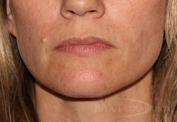 Fillers After - Paramus, NJ Fillers After - Paramus, NJ
