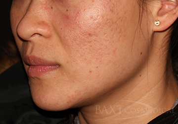 Fillers Before - Paramus, NJ Fillers Before - Paramus, NJ