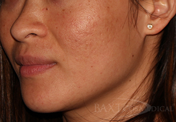 Fillers After - Paramus, NJ Fillers After - Paramus, NJ