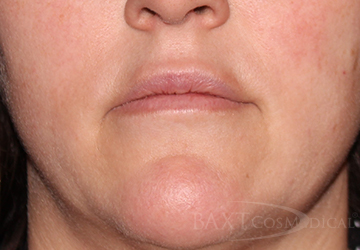 Fillers Before - Paramus, NJ Fillers Before - Paramus, NJ