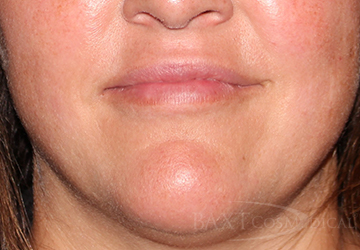 Fillers After - Paramus, NJ Fillers After - Paramus, NJ