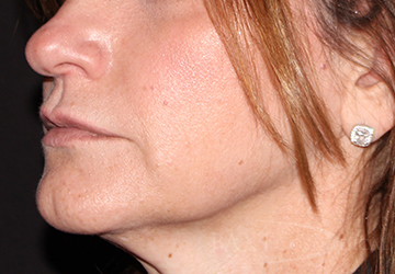 Fillers Before - Paramus, NJ Fillers Before - Paramus, NJ