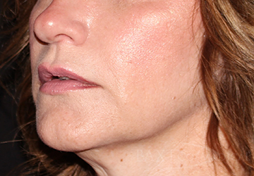 Fillers After - Paramus, NJ Fillers After - Paramus, NJ