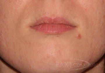 Fillers Before - Paramus, NJ Fillers Before - Paramus, NJ