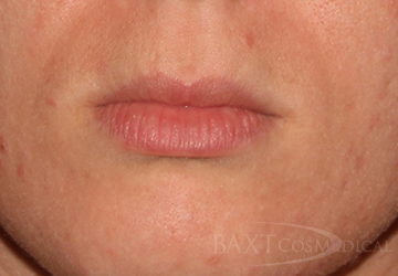 Fillers After - Paramus, NJ Fillers After - Paramus, NJ