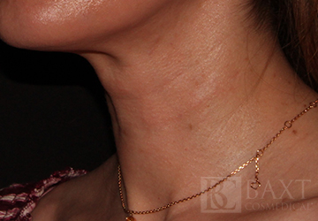 Fillers Before - Paramus, NJ Fillers Before - Paramus, NJ