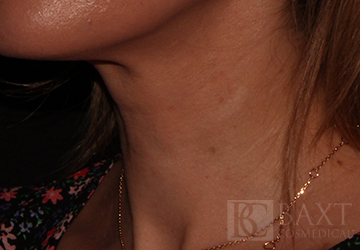 Fillers After - Paramus, NJ Fillers After - Paramus, NJ