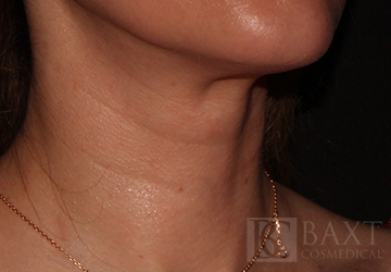 Fillers Before - Paramus, NJ Fillers Before - Paramus, NJ