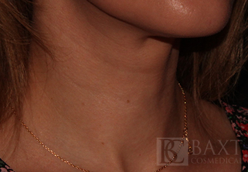 Fillers After - Paramus, NJ Fillers After - Paramus, NJ