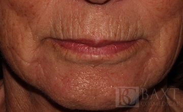 Fillers Before - Paramus, NJ Fillers Before - Paramus, NJ