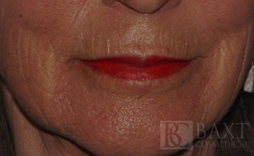 Fillers After - Paramus, NJ Fillers After - Paramus, NJ