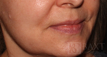 Fillers Before - Paramus, NJ