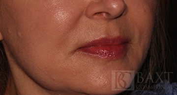 Fillers After - Paramus, NJ