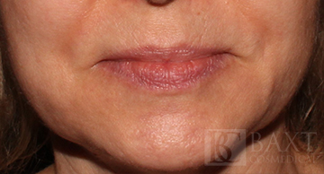 Fillers Before - Paramus, NJ