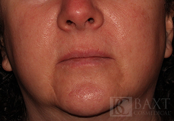 Fillers Before - Paramus, NJ Fillers Before - Paramus, NJ