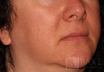 Fillers After - Paramus, NJ Fillers After - Paramus, NJ