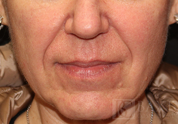 Fillers Before - Paramus, NJ Fillers Before - Paramus, NJ