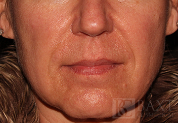 Fillers After - Paramus, NJ Fillers After - Paramus, NJ