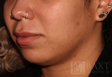 Fillers Before - Paramus, NJ