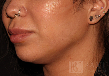 Fillers After - Paramus, NJ Fillers After - Paramus, NJ