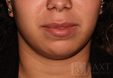 Fillers Before - Paramus, NJ