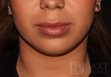 Fillers After - Paramus, NJ