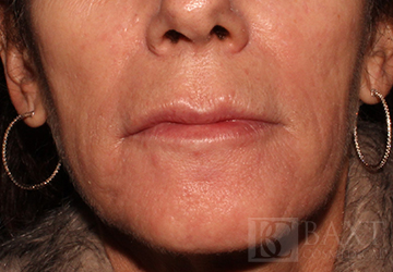 Fillers After - Paramus, NJ Fillers After - Paramus, NJ
