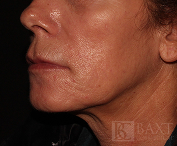 Fillers Before - Paramus, NJ Fillers Before - Paramus, NJ