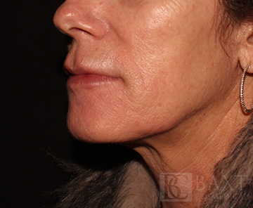 Fillers After - Paramus, NJ Fillers After - Paramus, NJ