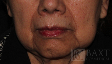 Fillers Before - Paramus, NJ Fillers Before - Paramus, NJ