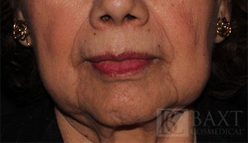 Fillers After - Paramus, NJ Fillers After - Paramus, NJ