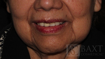 Fillers Before - Paramus, NJ Fillers Before - Paramus, NJ