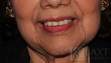 Fillers After - Paramus, NJ Fillers After - Paramus, NJ