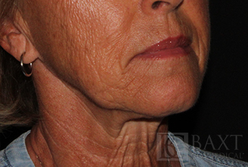 Fillers Before - Paramus, NJ Fillers Before - Paramus, NJ