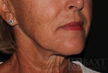 Fillers After - Paramus, NJ Fillers After - Paramus, NJ