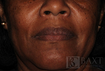 Fillers After - Paramus, NJ Fillers After - Paramus, NJ