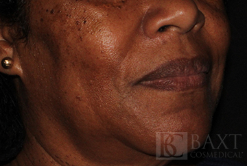 Fillers After - Paramus, NJ Fillers After - Paramus, NJ