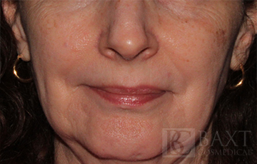 Fillers After - Paramus, NJ