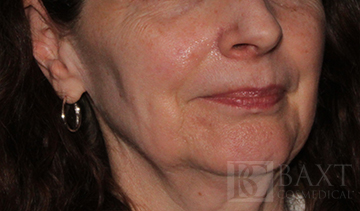 Fillers Before - Paramus, NJ