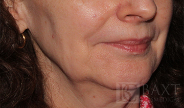 Fillers After - Paramus, NJ Fillers After - Paramus, NJ