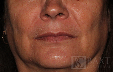 Fillers Before - Paramus, NJ