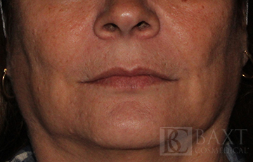 Fillers After - Paramus, NJ